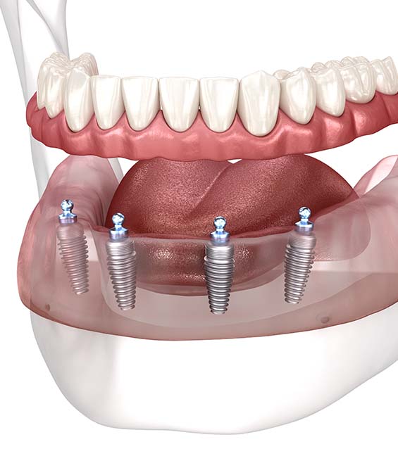 implant Denture in Lindsay