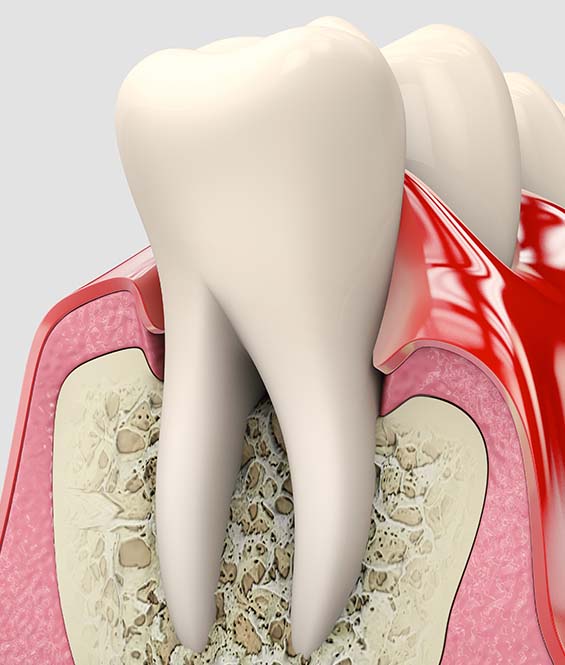periodontics in Lindsay