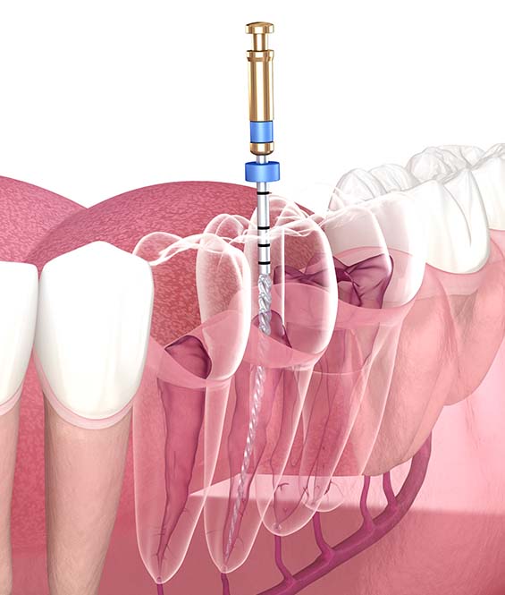 endodontics in Lindsay